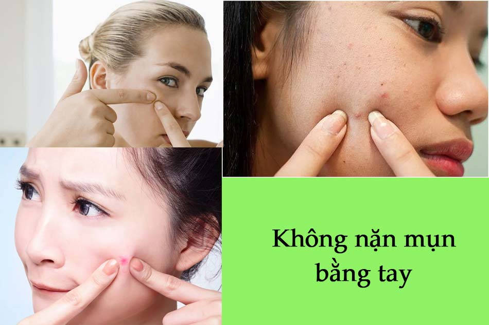 Không nặn mụn bằng tay