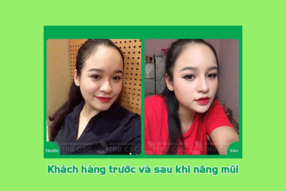 Khách hàng nâng mũi tại thẩm mỹ viện Thu Cúc