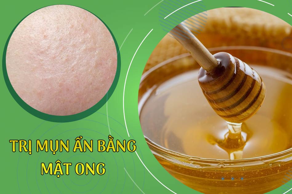 trị mụn ẩn bằng mật ong