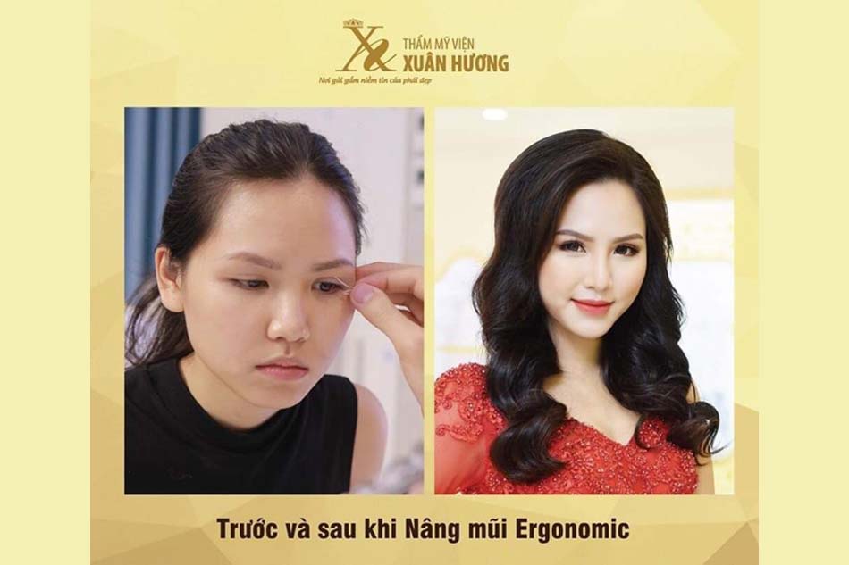 Phẫu thuật nâng mũi 