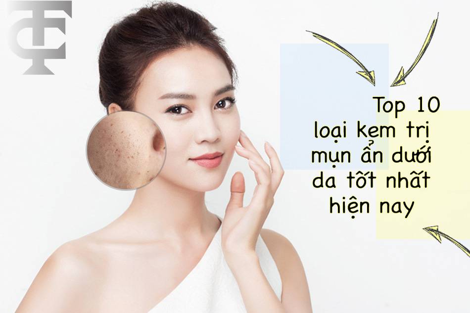 Top 10 loại kem trị mụn ẩn dưới da tốt nhất hiện nay