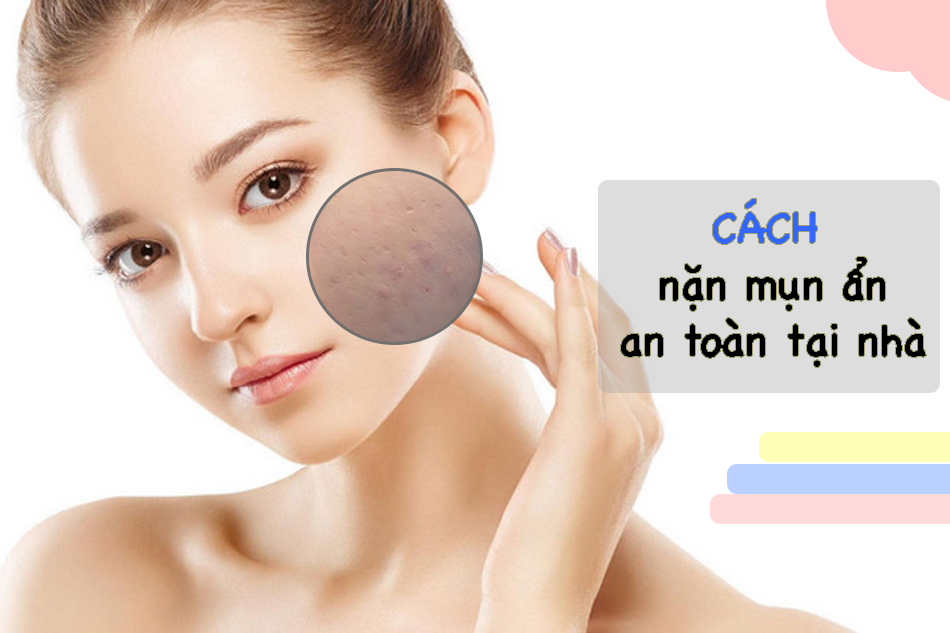 Cách nặn mụn ẩn an toàn tại nhà