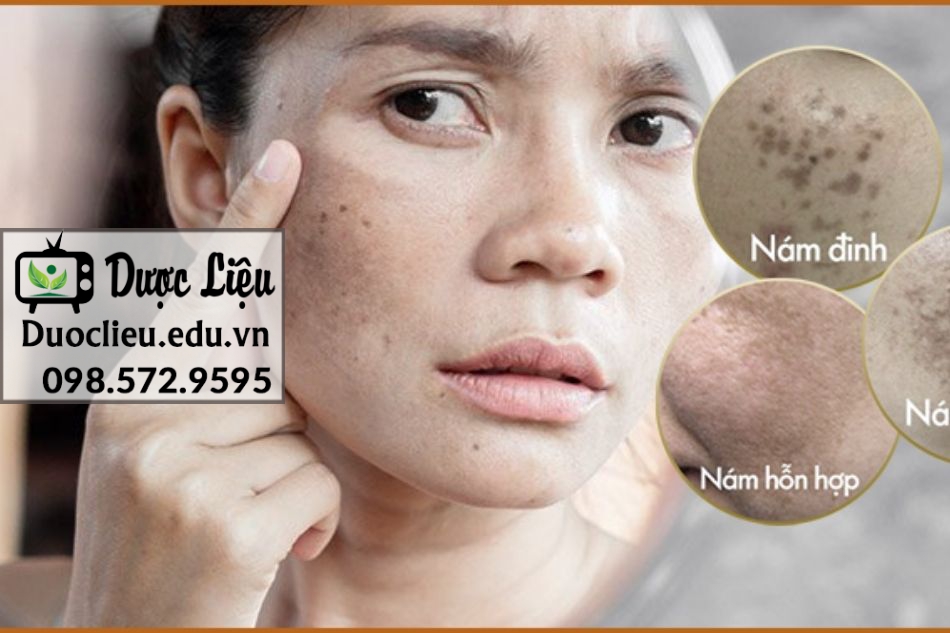 Serum Nuity Peel trị nám