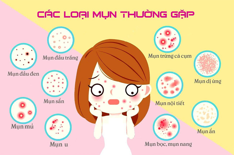 Các loại mụn bạn thường gặp phải